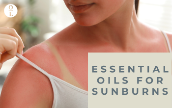 essential oils for sunburns